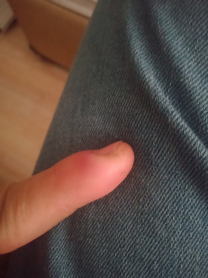Elimdeki şişlik nedir?