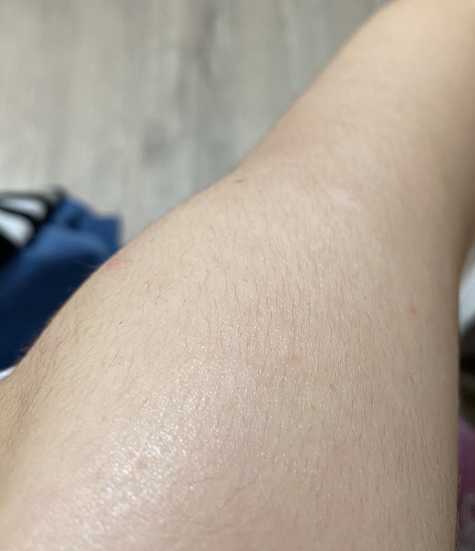 Sizce bu bölgelere lazer yaptırayım mı?