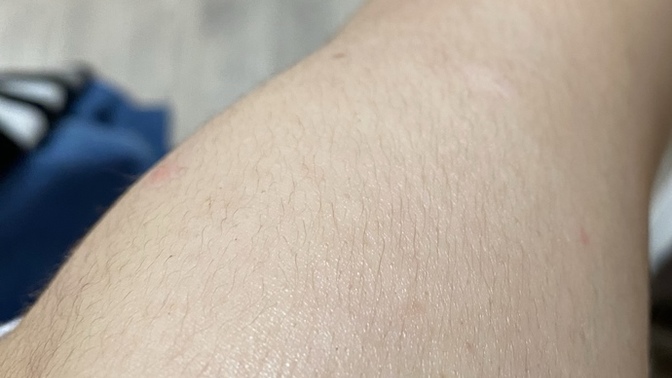 Sizce bu bölgelere lazer yaptırayım mı?