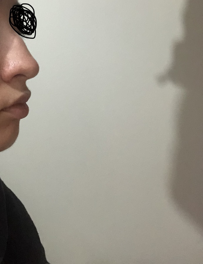 Estetik düşünüyorum kemer dolayısıyla siz olsanız yaptırır mıydınız çok mu kötü duruyor?