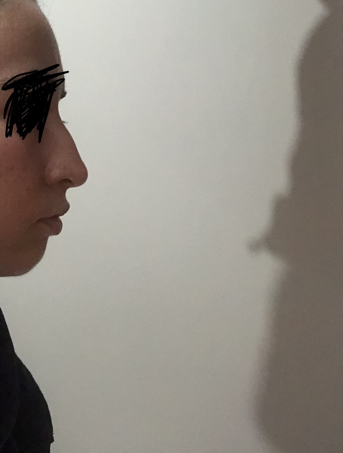 Estetik düşünüyorum kemer dolayısıyla siz olsanız yaptırır mıydınız çok mu kötü duruyor?