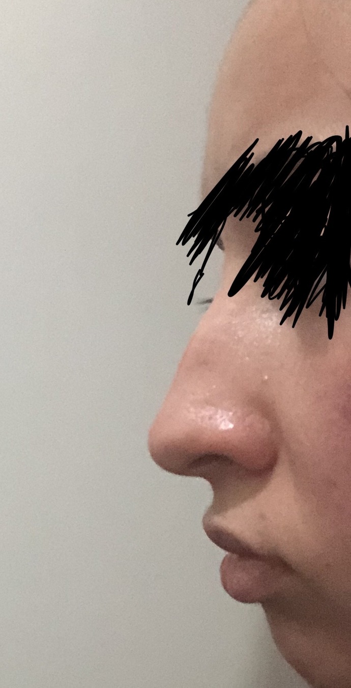 Estetik düşünüyorum kemer dolayısıyla siz olsanız yaptırır mıydınız çok mu kötü duruyor?
