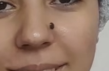 Benim aldırmak istiyorum yara olur mu ne kadar sürede geçer iz?