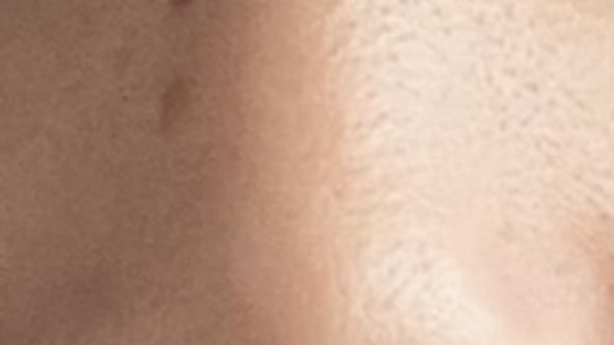 Burnumdakş benleri sildirsem mi iz kalır mı?