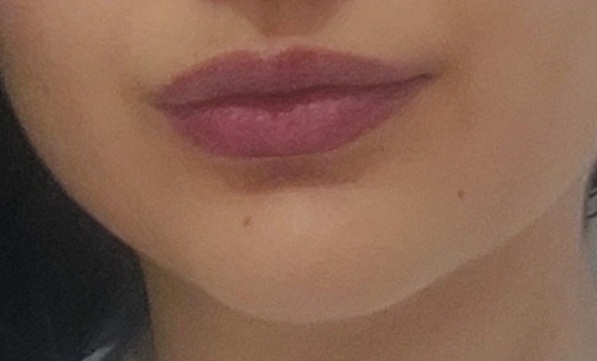 Sizce dudaklarıma dolgu gerek mi?