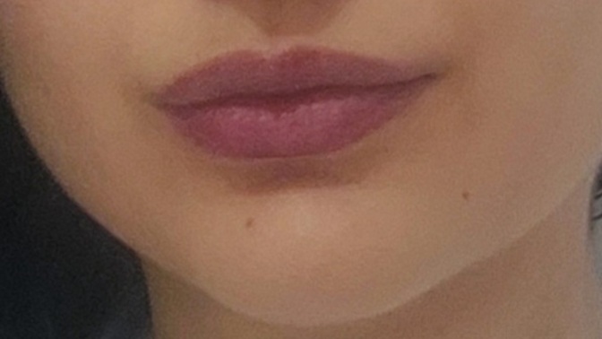 Sizce dudaklarıma dolgu gerek mi?