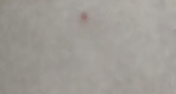 Bacagimda kirmizi bi leke cikti?