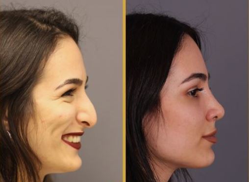 Estetik yaptırsaydınız, eski estetiksiz fotoğraflarınızı sosyal medya hesaplarınızdan siler miydiniz?