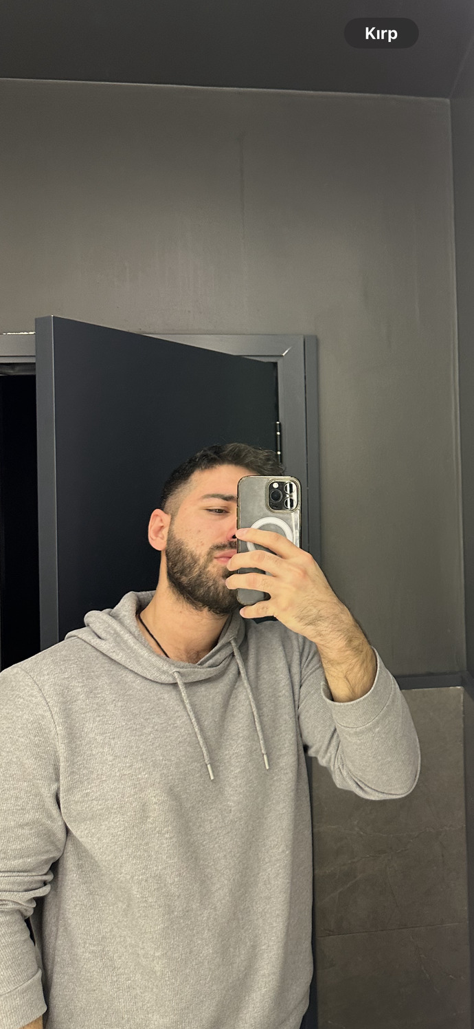 Yüzünde sivilce izi olan biri yakışıklı olamaz mı?