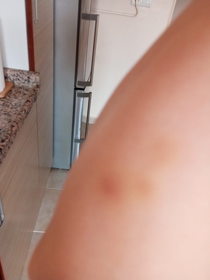 Günaydın, bir kaç gündür vücudumun çeşitli yerlerin de morarıklar oluyor bunun sebebi ne olabilir?