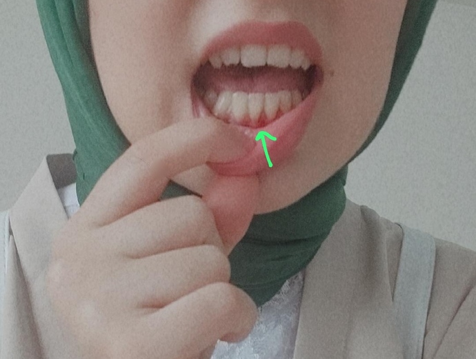 Diş eti neden şişer ve kızarır?