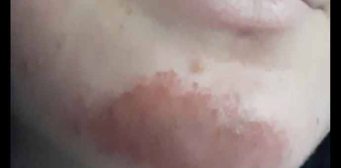 Yüzüm durup dururken böyle oldu nasıl geçer?