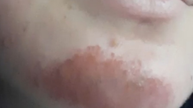 Yüzüm durup dururken böyle oldu nasıl geçer?