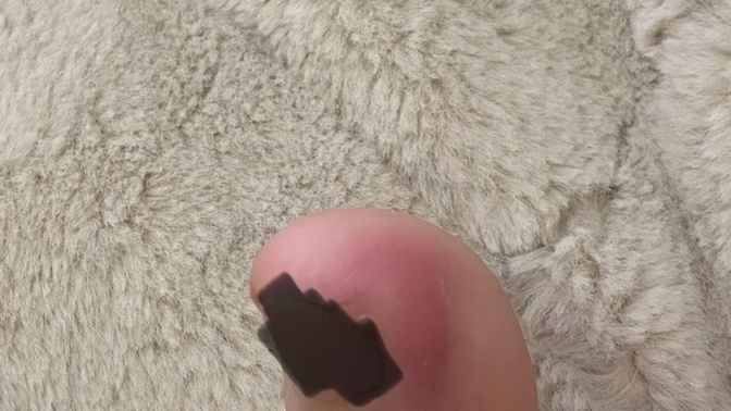 Ayak parmağım çürüyor mu?