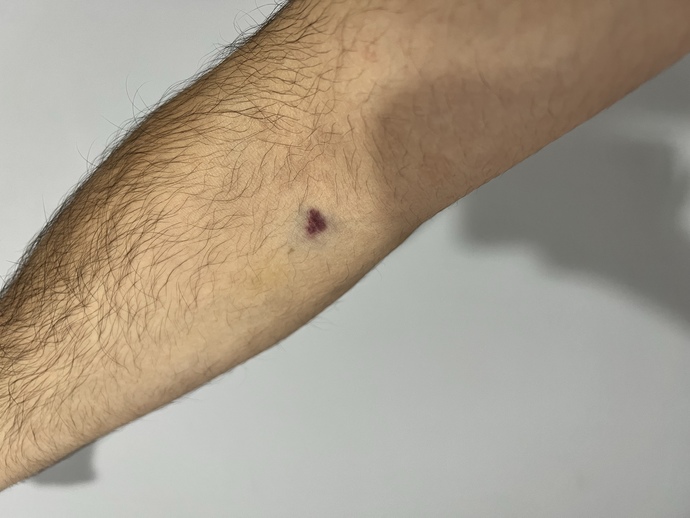 Kan verdim, bu kadar morarması normal mi?