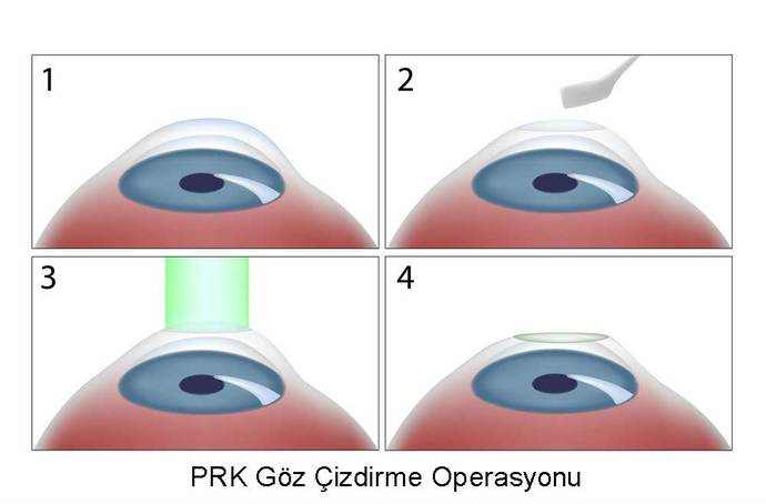 Miyopum, artık gözlük kullanmak istemiyorum. Hangisi daha sağlıklı sizce?