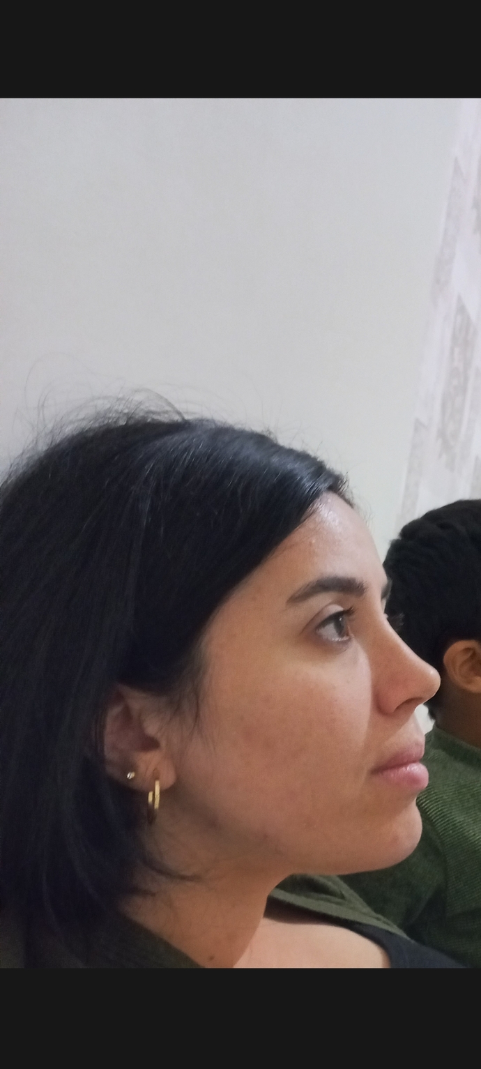 Burun ameliyatı oldum, öncesi ve sonrası böyle! Sizce nasıl olmuş?