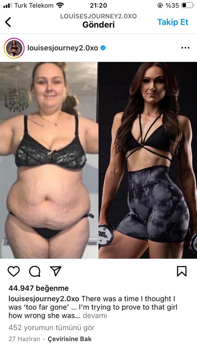 Hastalıklardan sonra vücudum mahvoldu. Göbek kısmına liposuction dışında çözüm varm?