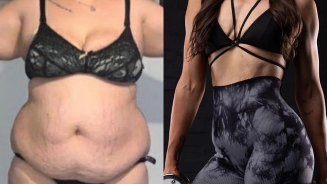 Hastalıklardan sonra vücudum mahvoldu. Göbek kısmına liposuction dışında çözüm varm?