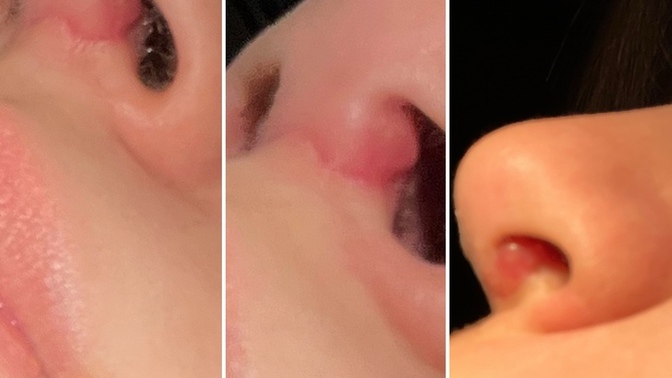 Burun estetiği oldum ve dikiş yerinde ara sıra böyle bir şişme oluyor doktora gitmeli miyim?