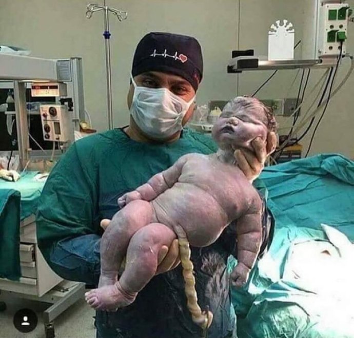 Doğal doğumla dünyaya gelmiş en büyük bebek, 7.9 kg ağırlığında ve 57,5 cm boyunda! Siz kaç kg doğmuşsunuz?