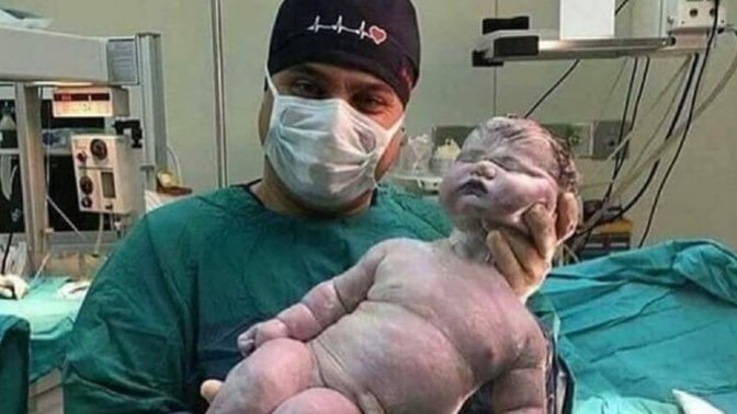 Doğal doğumla dünyaya gelmiş en büyük bebek, 7.9 kg ağırlığında ve 57,5 cm boyunda! Siz kaç kg doğmuşsunuz?