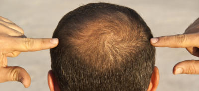 Bolgesel Sac Dokulmesine Ne Iyi Gelir Kizlarsoruyor