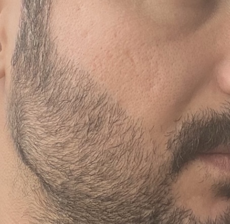 Yüzümdeki bu deliklerin çözümü nedir?