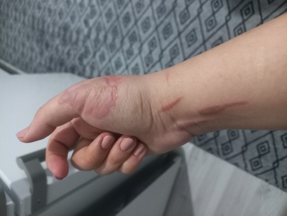 Elimde yağ patladı. Silverdin kullanıyorum, iz kalır mı?