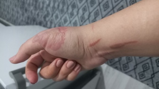 Elimde yağ patladı. Silverdin kullanıyorum, iz kalır mı?