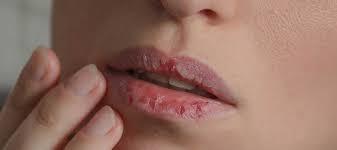 Aşırı dudak kuruluğu için önerebileceğiniz lip balm var mı?