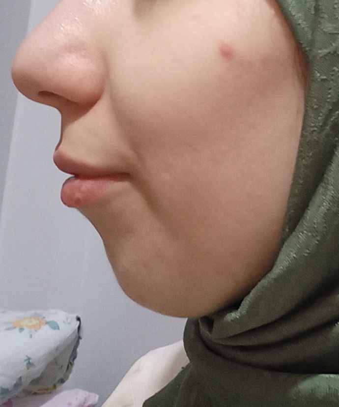 Alt çenem çok mu geride? Benim gibi olan var mı?