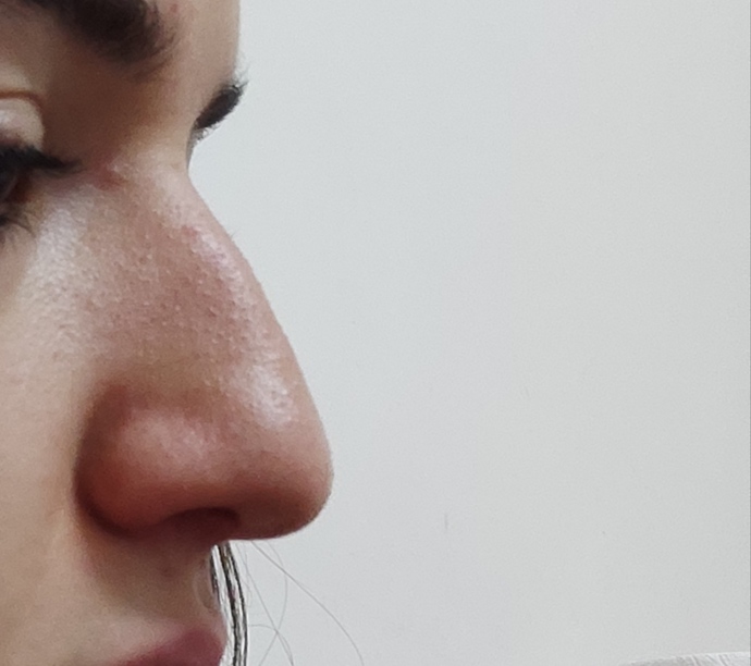 Burnum aşırımı kemerli beni çok rahatsız ediyor. Yaptırırsam ne kadar tutar?