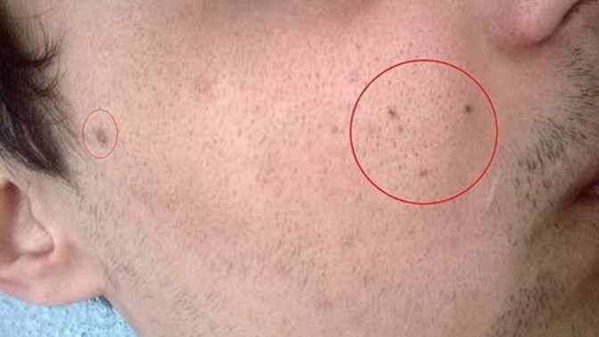 Sizde de sonradan siyah nokta çıkıyor mu?