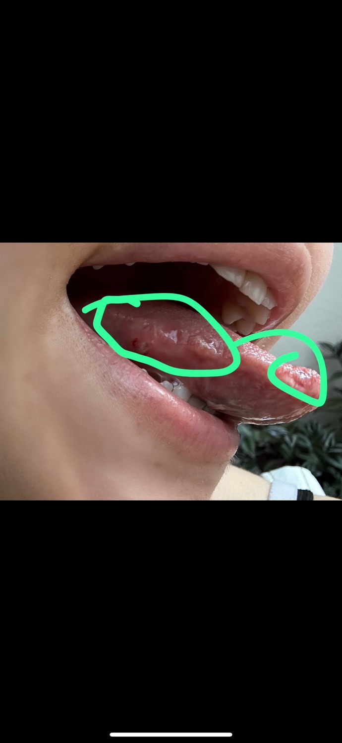 Dilimde hep uçuk çıktı yemek yiyemiyorum ne yapsam geçer?