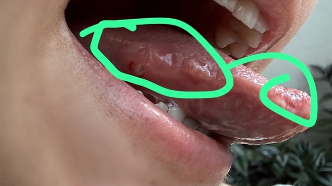 Dilimde hep uçuk çıktı yemek yiyemiyorum ne yapsam geçer?