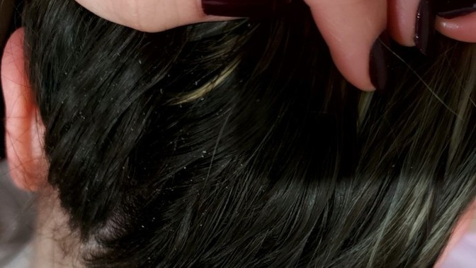 Keratin kepeklenme yapar mı?