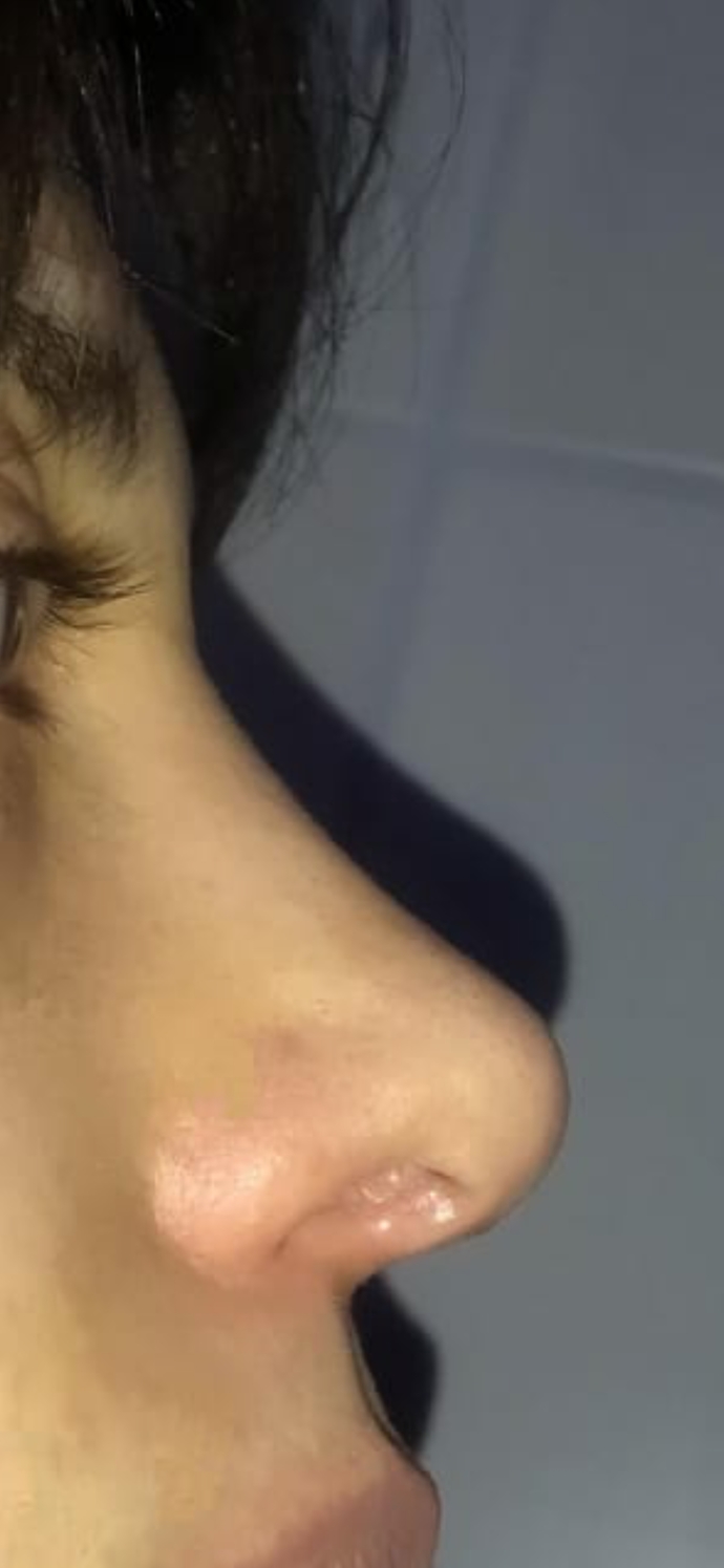 Kuzenim ve ben farklı doktorlara burun estetiği yaptırdık. Sizce hangisi daha başarılı olmuş?
