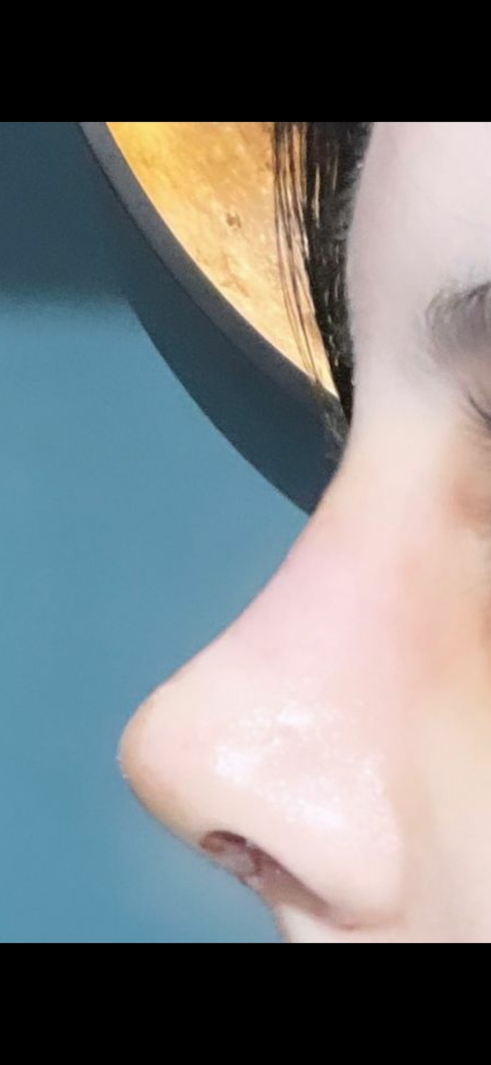 Kuzenim ve ben farklı doktorlara burun estetiği yaptırdık. Sizce hangisi daha başarılı olmuş?