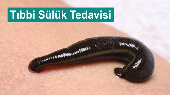 Hijyenik bir tıbbi sülük tedavisi nerede bulabilirim?