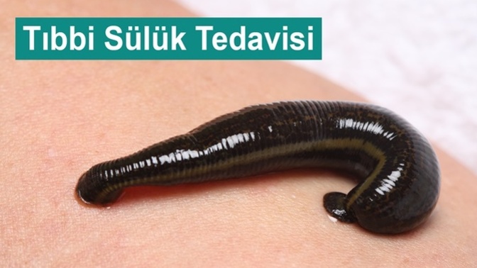 Hijyenik bir tıbbi sülük tedavisi nerede bulabilirim?