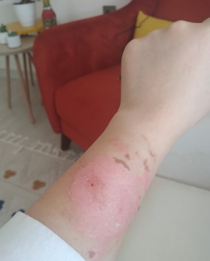 Kaynar su yanığı izi kalır mı ya da ne kadar sürede tamamen iyileşir?
