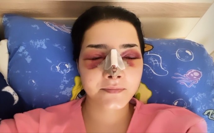 Burun ameliyatı oldum. Bu şişlik normal mi, ne yapmalıyım?