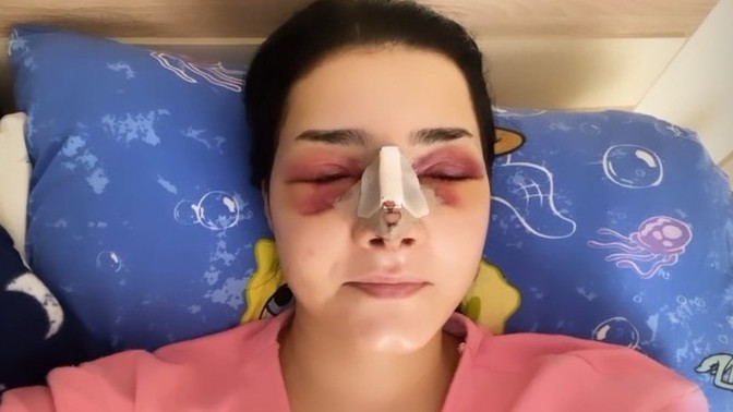 Burun ameliyatı oldum. Bu şişlik normal mi, ne yapmalıyım?
