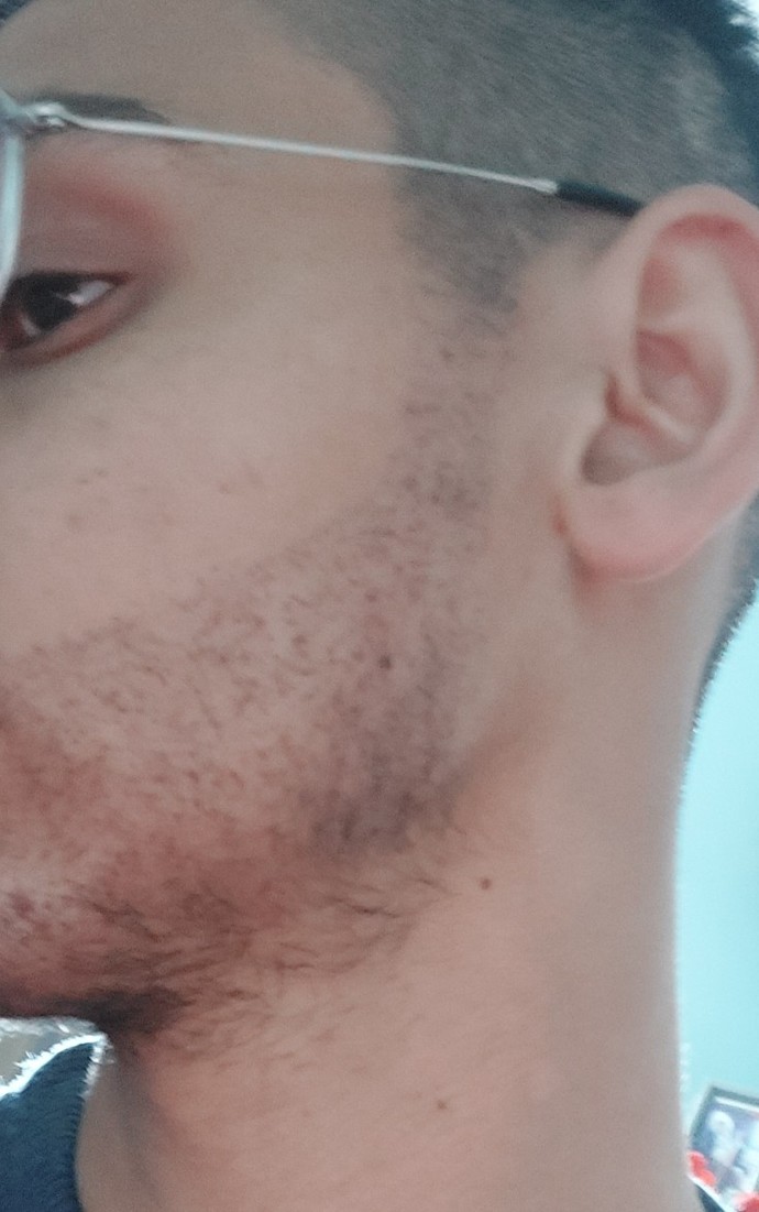 Yüzümdeki bu siyahlığı nasıl hemen geçirebilirim?