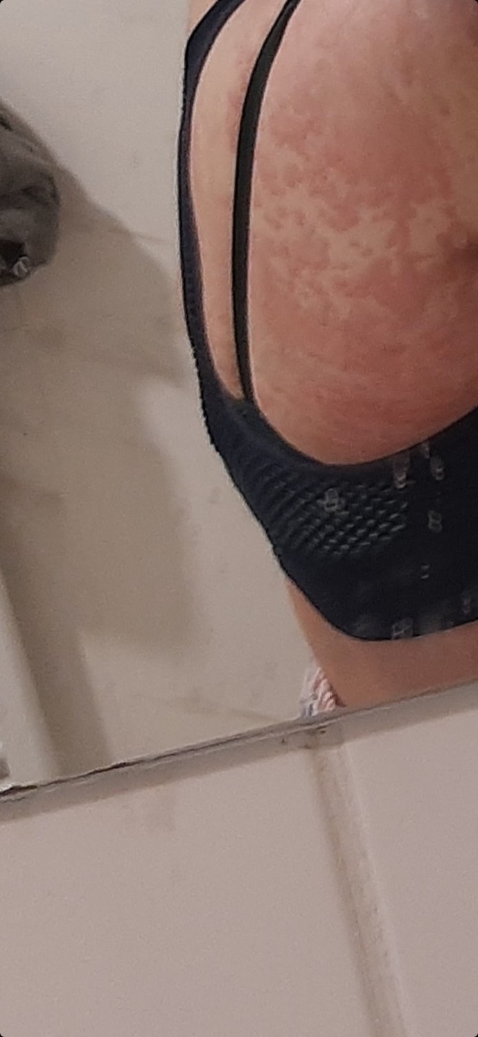 Sırtıma bir şey oldu, her yerim böyle. Neden olabilir?