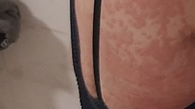 Sırtıma bir şey oldu, her yerim böyle. Neden olabilir?