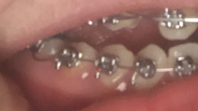 3 gün önce braketlemem yapıldı ama bu tel yerinden oynamış neden böyle?