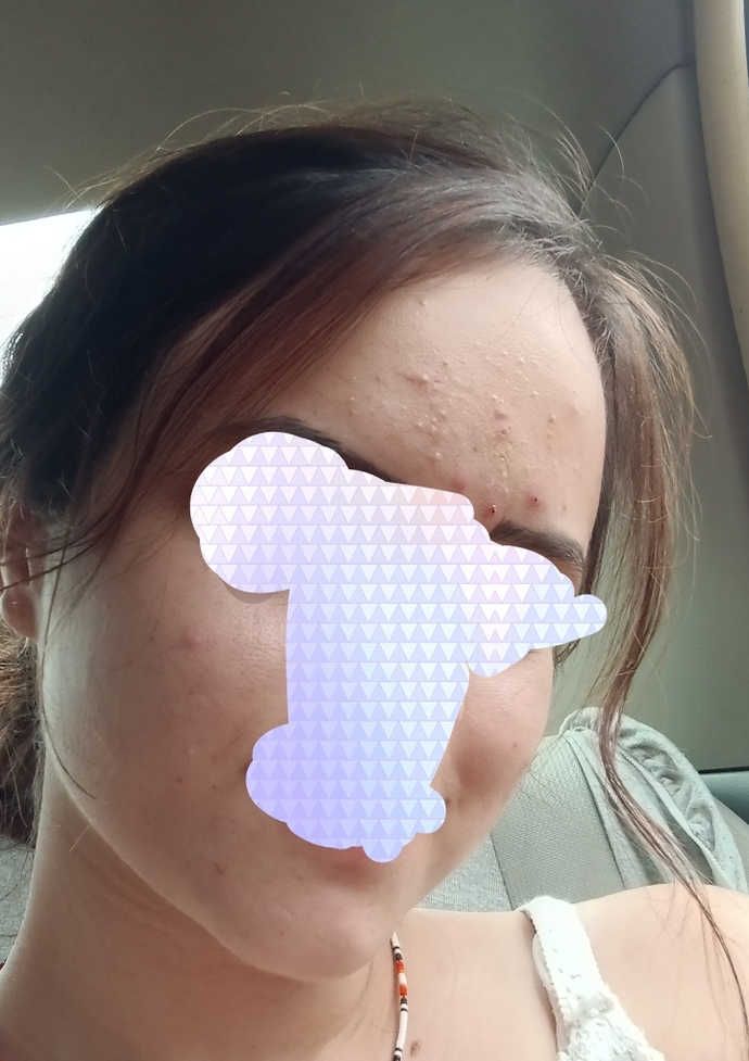 Cildim bu durumda cildiyeci roaccutane kullanacaksın dedi. Kullanmalı mıyım?
