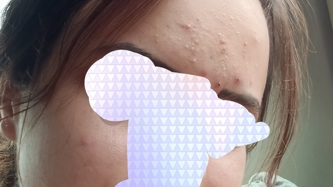 Cildim bu durumda cildiyeci roaccutane kullanacaksın dedi. Kullanmalı mıyım?